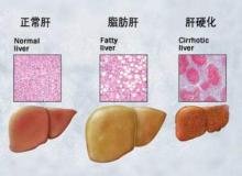 全自动生化分析仪品牌解答脂肪肝的患病率