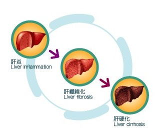 全自动生化分析仪厂家分析肝炎与肝硬化的关系